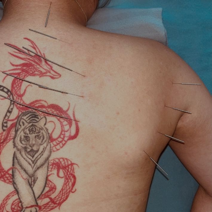 Dry Needling Photo 2