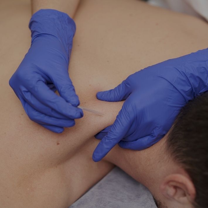 Dry Needling Photo 3
