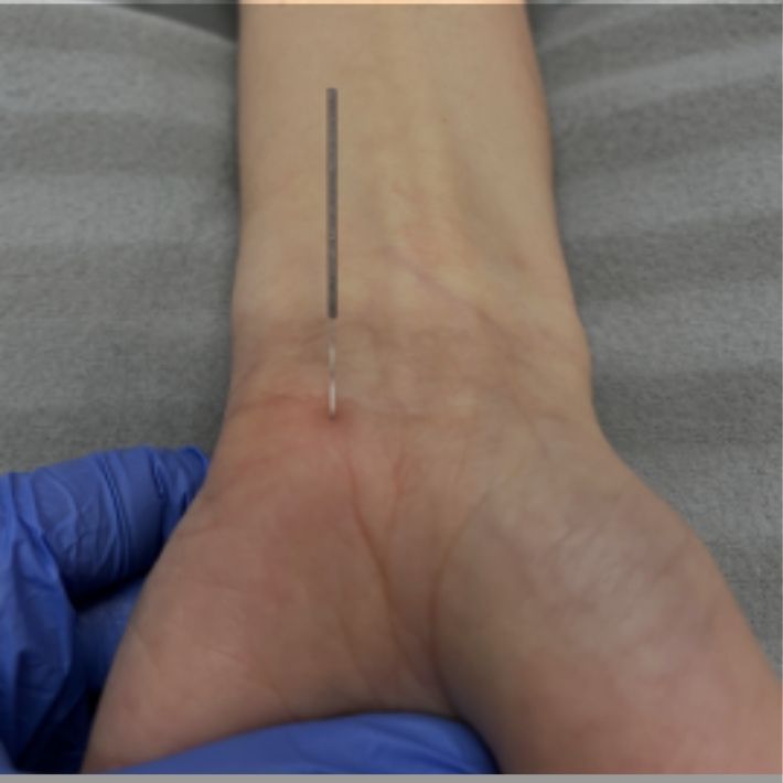 Dry Needling Photo 1